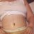 Pełna abdominoplastyka ze zszyciem mięśni plus liposukcja boczków