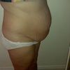 Liposukcja brzucha i bioder - 12 litrów tłuszczu!