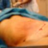 Liposukcja brzucha i bioder - 12 litrów tłuszczu!