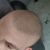 Mikropigmentacja skóry głowy - zagęszczenie włosów