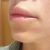 Powiększanie ust Teosyal Kiss 1 ml - efekt małpiej twarzy - grudki i asymetria warg