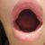 Powiększanie ust Teosyal Kiss 1 ml - efekt małpiej twarzy - grudki i asymetria warg