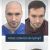 Jestem bardzo zadowolony z przeszczepu włosów w full face clinic