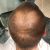 Przeszczep włosów w Clinic Osipowicz & Turkowski 