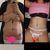 Abdominoplastyka wraz z liposukcją boczków