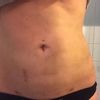 Liposukcja w Kriocentrum - efekty widoczne od razu po zabiegu