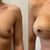 Powiększenie Biustu implantami Motiva 400ml