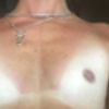 Powiekszanie piersi, czy dobrze wybralam implant?