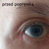 Boczna fałda przy oku po blefaroplastyce