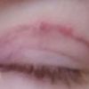 Widoczność blizny po blepharoplastyce i poranne obrzęki 