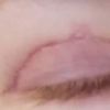 Widoczność blizny po blepharoplastyce i poranne obrzęki 