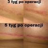 Wygląd blizn 5 tyg po operacji