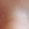 Moje dziecko ma coloboma/ubytek/szczelinę na powiece