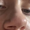 Krzywe dziurki w nosie/septoplastyka nfz