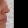Implant części chrzestnej nosa
