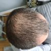 Przeszczep włosów metoda bht