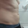Liposukcja i jej RODZAJE / kriolipoliza