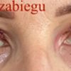 duża asymetria po plastyce powiek