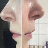 Korekta asymetrii dziurek w nosie