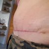 Plastyka brzucha i liposukcja 