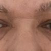 Nieudana operacji dolnych powiek - spuchnięte oczy