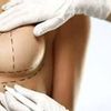 Implant pod gruczoł czy pod mięsień?