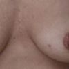 Nie rozwne piersi ponoperacji implantami **hp