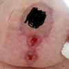 Trudno gojące się rany po lifcie plus implant