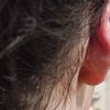 Aptos korekcja odstających uszu