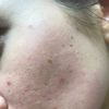 Laser frakcyjny CO2 efekt gorszy niz przed, powikłania, podniszczona skora