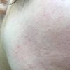 Laser frakcyjny CO2 efekt gorszy niz przed, powikłania, podniszczona skora