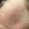 Laser frakcyjny CO2 efekt gorszy niz przed, powikłania, podniszczona skora