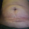 Zrosty po liposukcji Body Jet