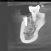 Zabieg założenia implantu zębowego dolna 5-tka