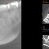 Zabieg założenia implantu zębowego dolna 5-tka