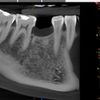 Zabieg założenia implantu zębowego dolna 5-tka