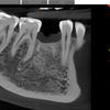 Zabieg założenia implantu zębowego dolna 5-tka