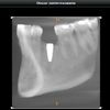 Zabieg założenia implantu zębowego dolna 5-tka