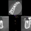 Zabieg założenia implantu zębowego dolna 5-tka