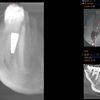 Zabieg założenia implantu zębowego dolna 5-tka