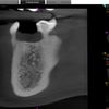 Zabieg założenia implantu zębowego dolna 5-tka