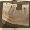 Zabieg założenia implantu zębowego dolna 5-tka