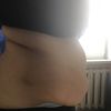 Liposukcja vaser lipo /vaser lipo hd 