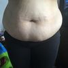 Liposukcja vaser lipo /vaser lipo hd 