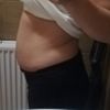 Abdominoplastyka-czy tak powinien wyglądać brzuch po plastyce?