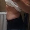 Abdominoplastyka-czy tak powinien wyglądać brzuch po plastyce?