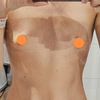 Powiekszanie piersi motivia ergonomix 355
