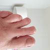 Pakce młotkowate + zabieg na haluksa