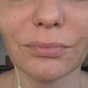 Operacja plastyczna ust czy korekta kwasem hialuronowym?