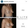 Implanty poniżej 240ml, lekarze, wasze opinie i efekty